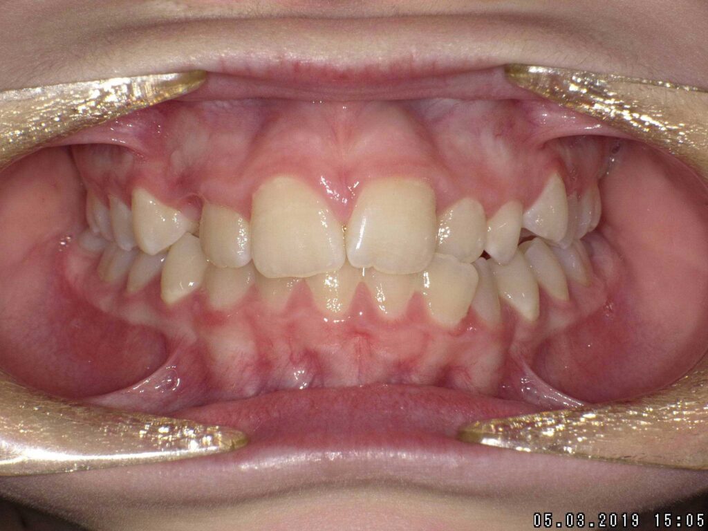 trattamento di chirurgia dentale bergamo per il recupero chirurgico ortodontico di canini inclusi