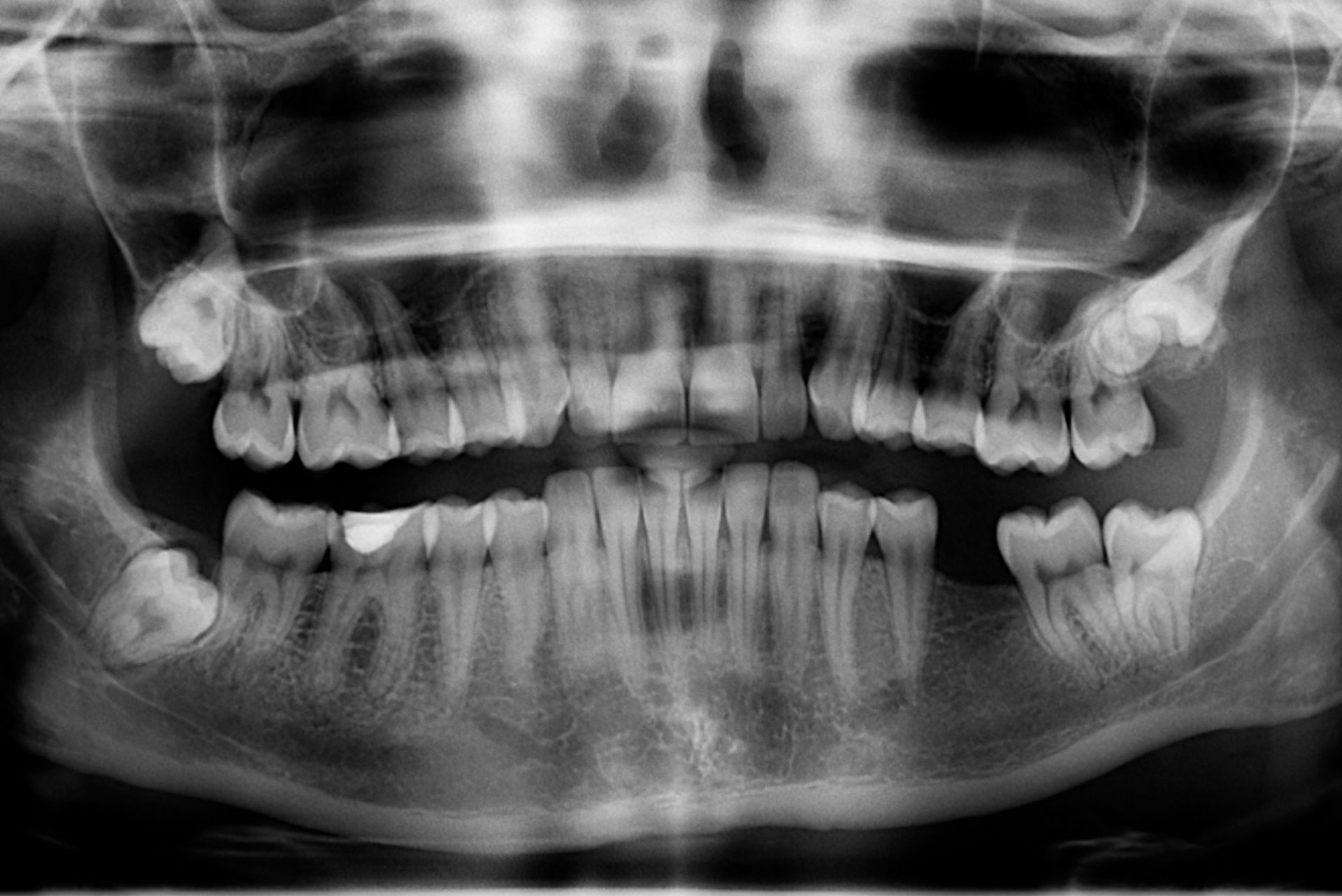 radiologia, denti, digitale