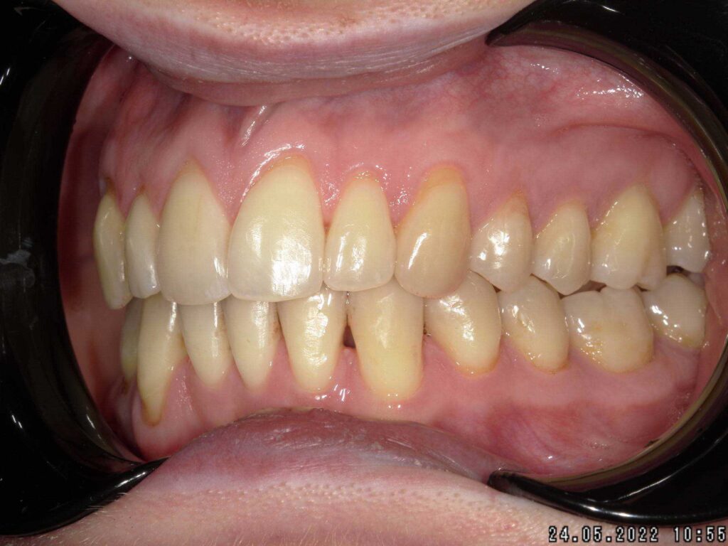 post trattamento, lato sinistro bocca, ortodonzia