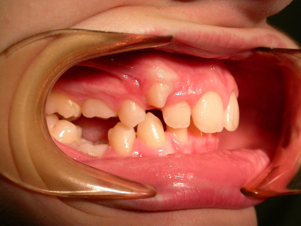 pre trattamento, lato destro bocca, ortodonzia