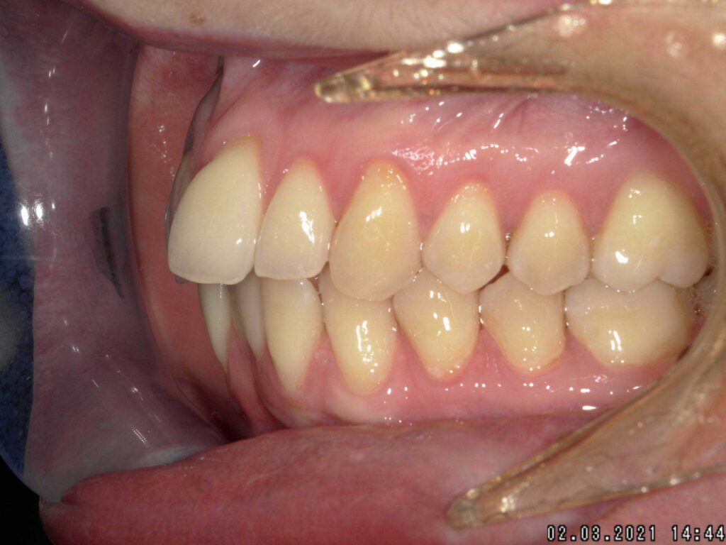pre trattamento, lato sinistro bocca, ortodonzia