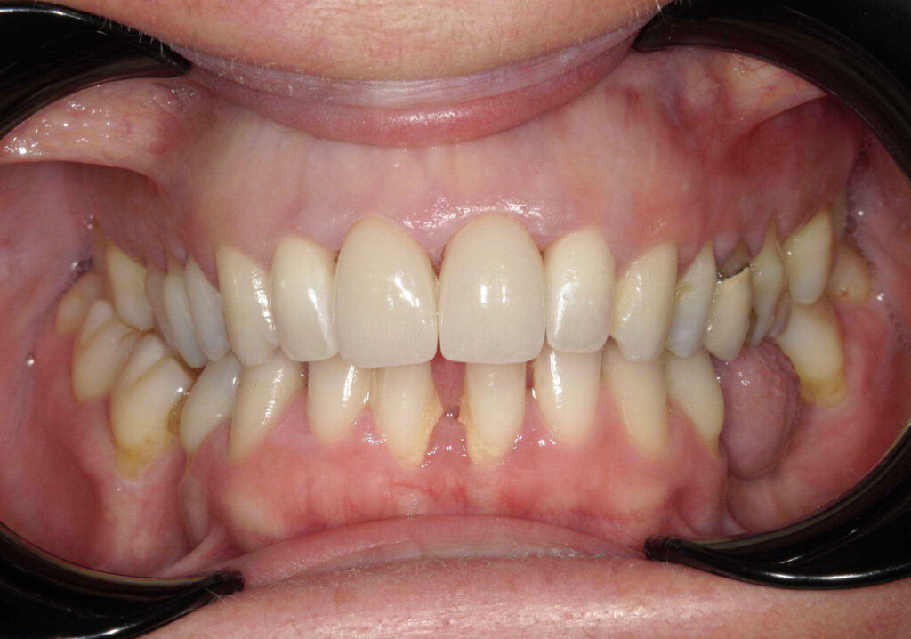 protesi dentali: faccette in ceramica post trattamento